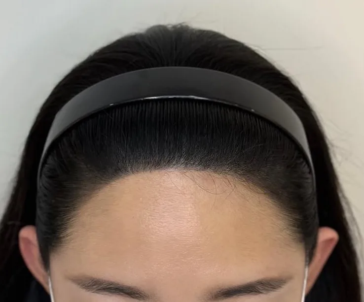 ヘアラインSMP 施術後の生え際