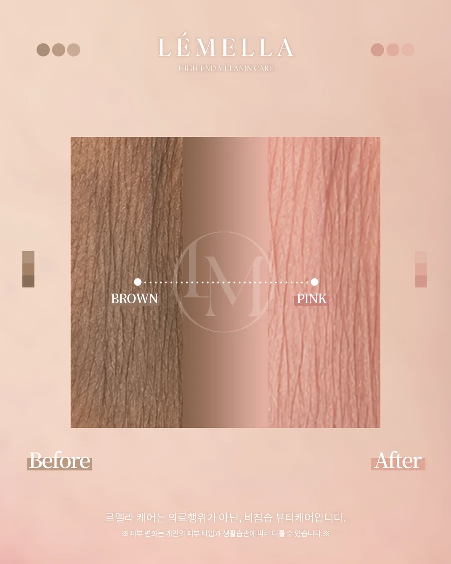メラニンケア(ルメラ) Before After 施術例 2