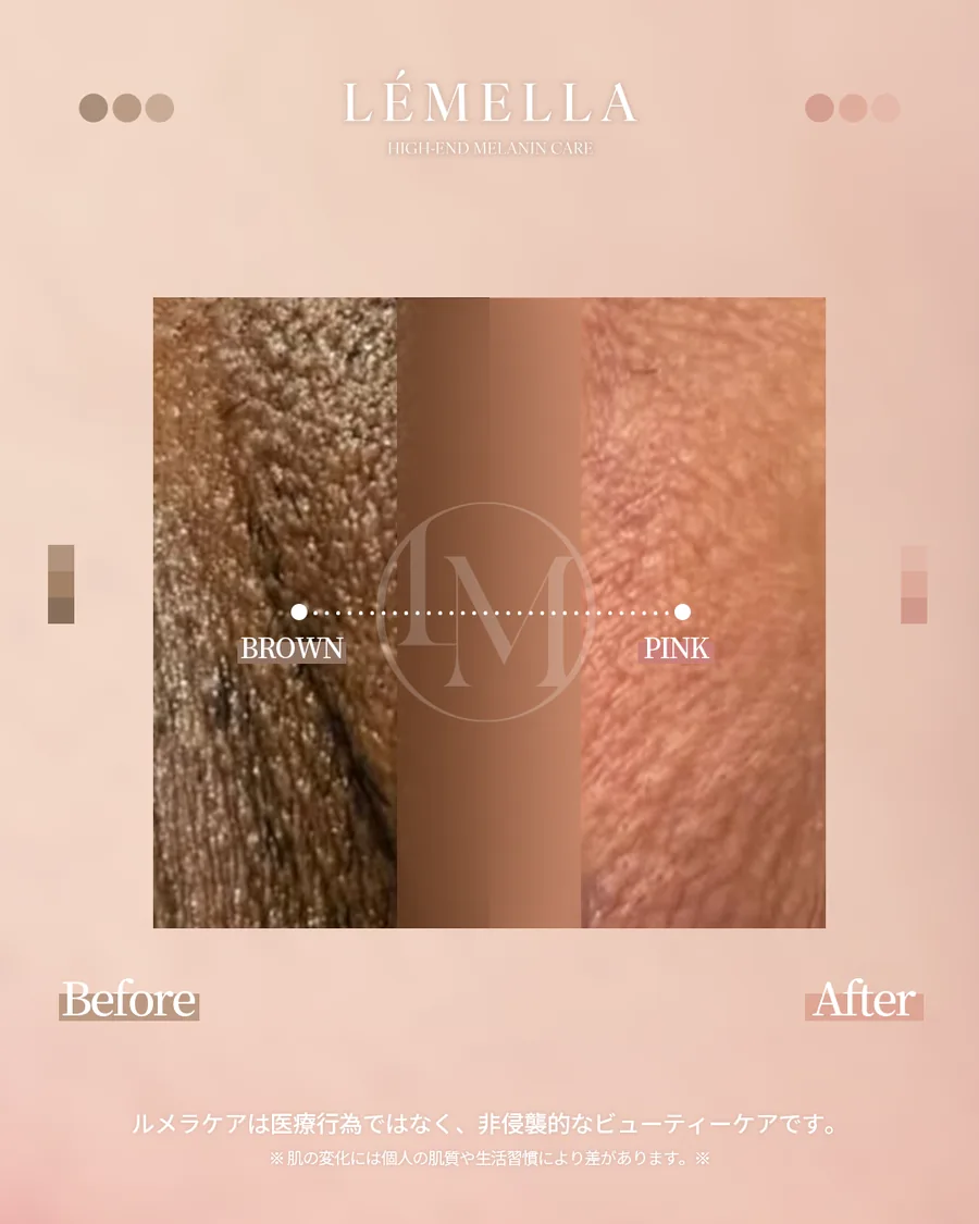 メラニンケア(ルメラ) Before After 施術例 14
