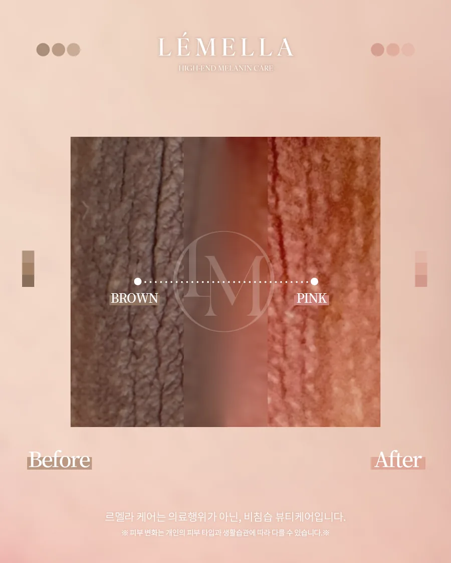 メラニンケア(ルメラ) Before After 施術例 19