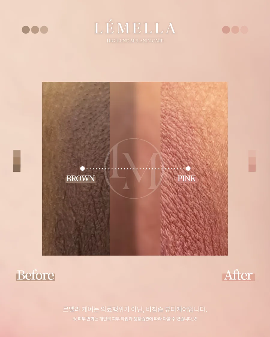メラニンケア(ルメラ) Before After 施術例 20