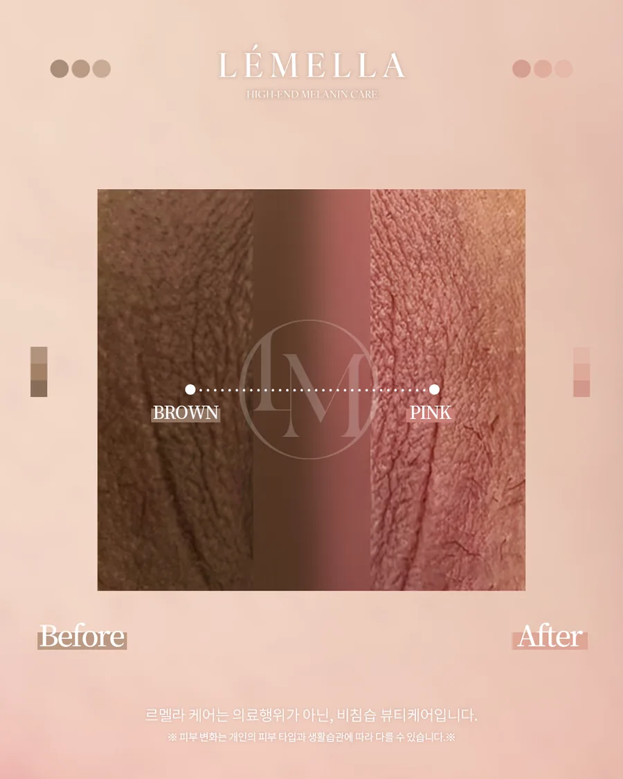 メラニンケア(ルメラ) Before After 施術例 21
