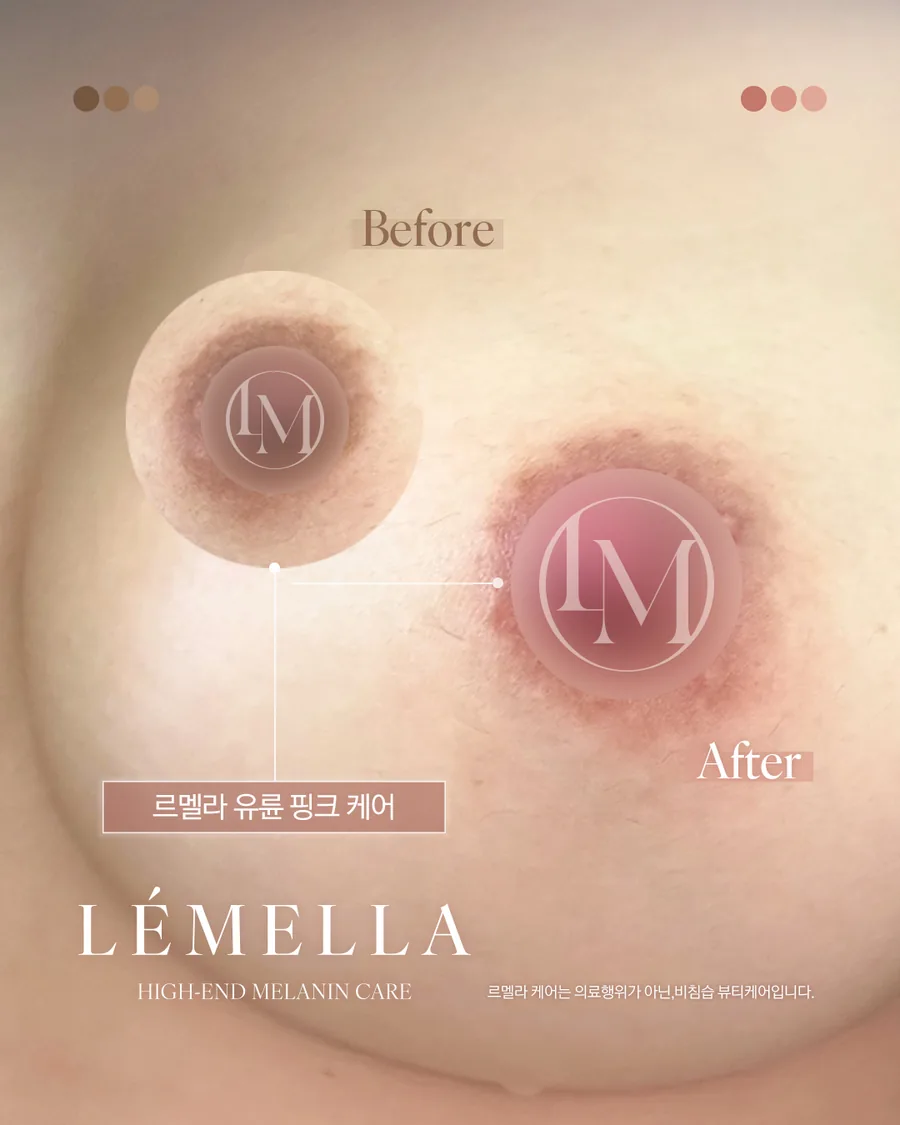 メラニンケア(ルメラ) Before After 施術例 66