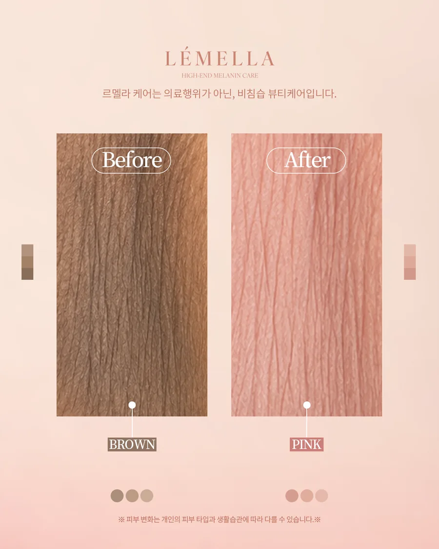 メラニンケア（ルメラ） Before After 施術例 1