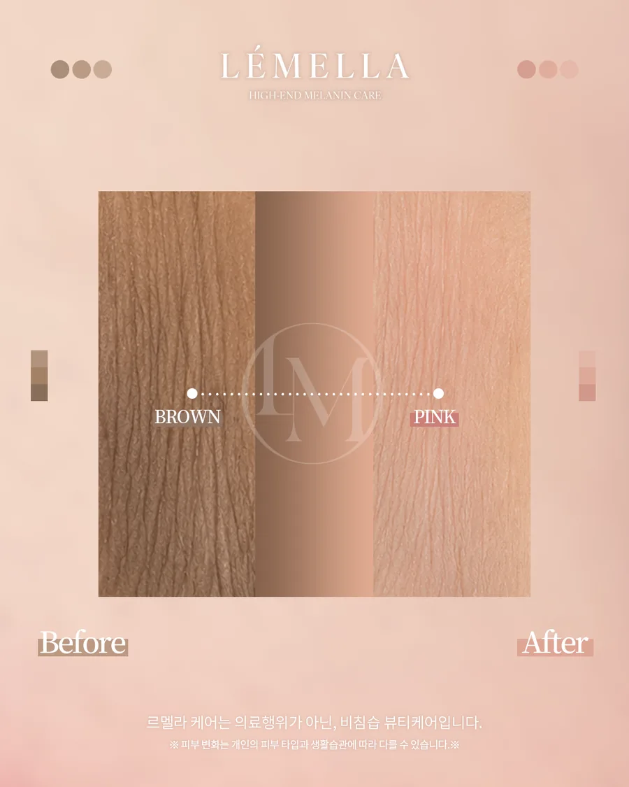 メラニンケア（ルメラ） Before After 施術例 4