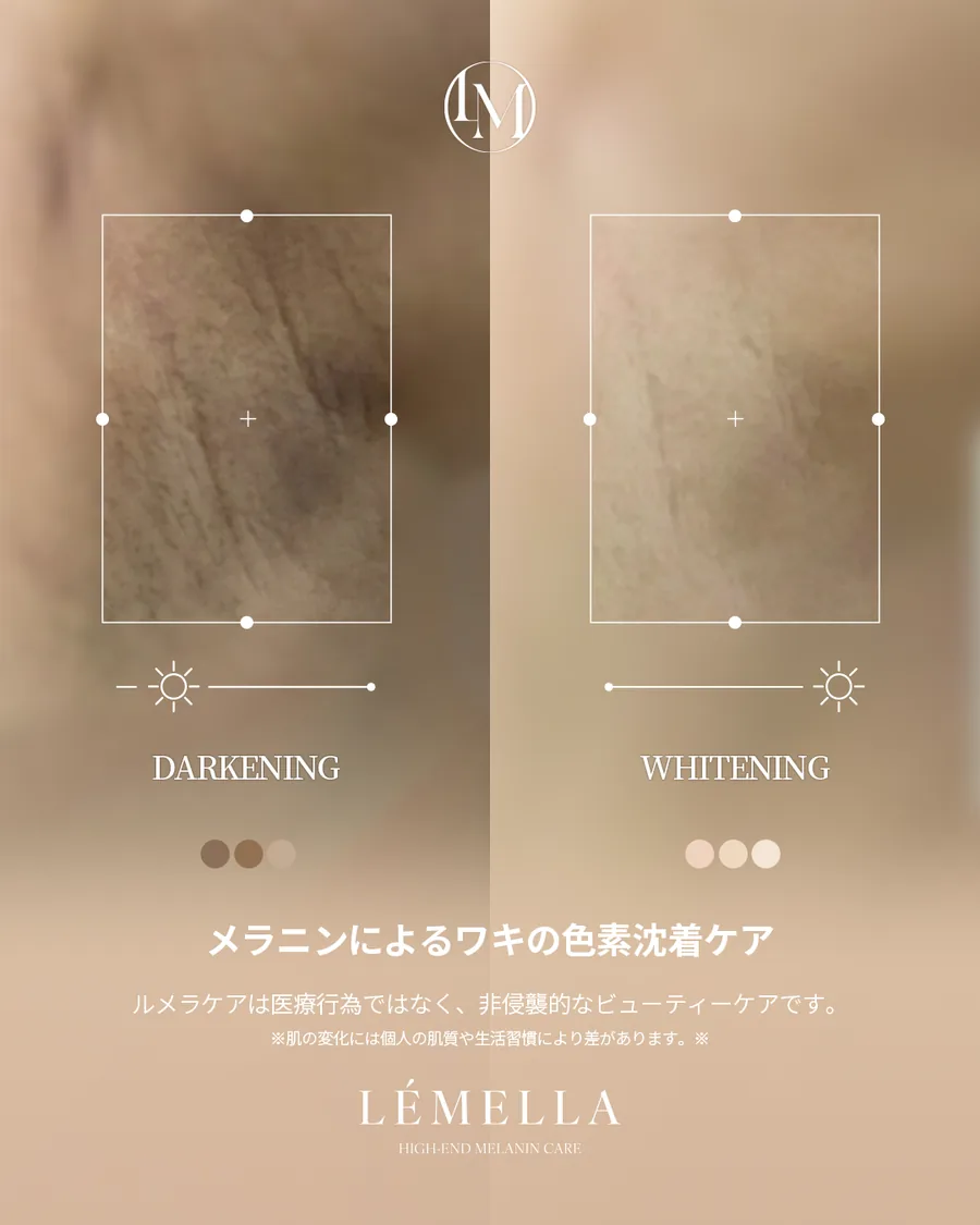 ルメラ メラニンケアの Before After 施術例 — 体の黒ずみ・色素沈着のケア エステールエステ