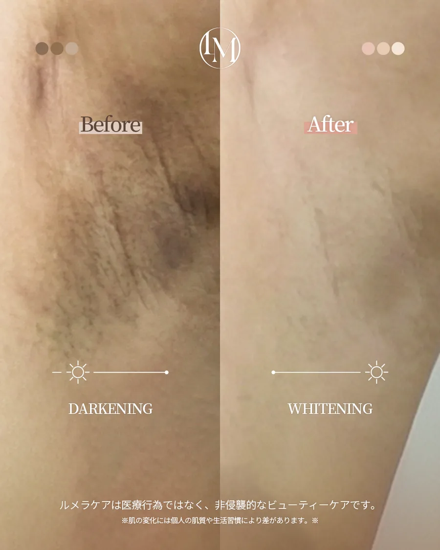 ルメラ メラニンケアの施術例 Before After — ブラウンからピンクへ明るいトーンを目指したケア エステールエステ