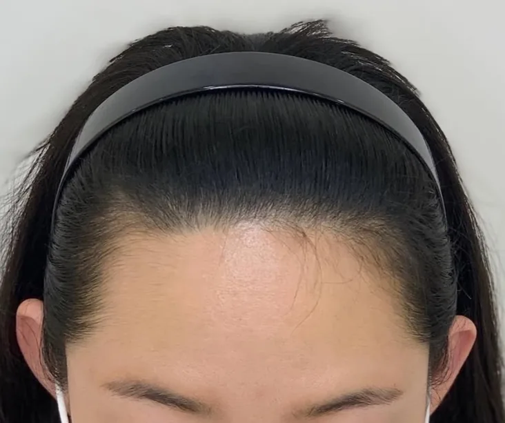 ヘアラインSMP Before After 施術例 1