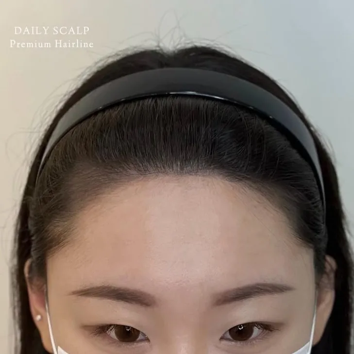 ヘアラインSMP Before After 施術例 4