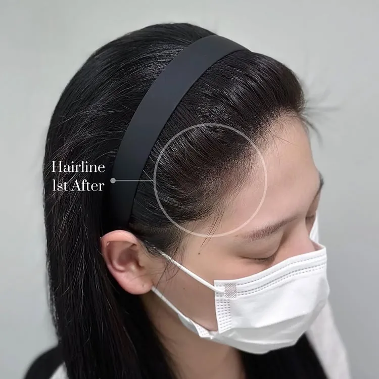ヘアラインSMP Before After 施術例 6