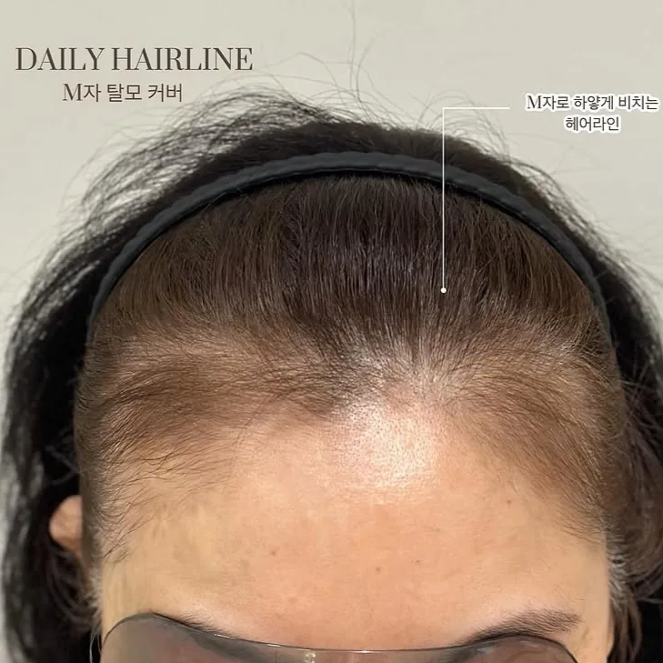 ヘアラインSMP Before After 施術例 8
