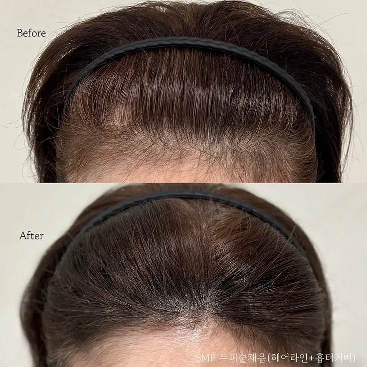ヘアラインSMP Before After 施術例 10