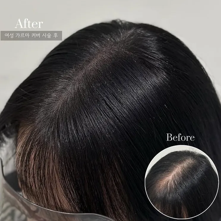 ヘアラインSMP Before After 施術例 11