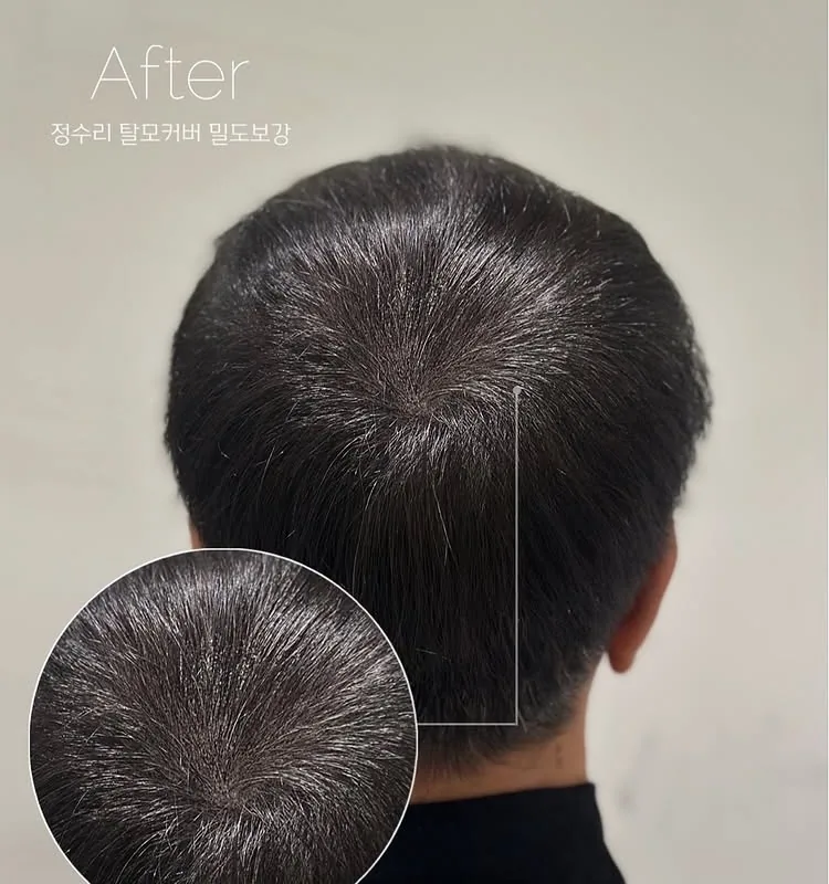 ヘアラインSMP Before After 施術例 13