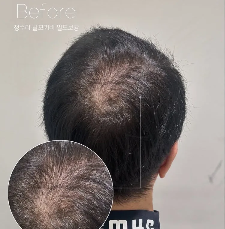 ヘアラインSMP Before After 施術例 14