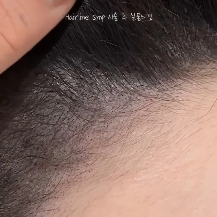 ヘアラインSMP Before After 施術例 15