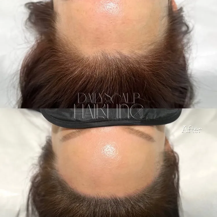 ヘアラインSMP Before After 施術例 16