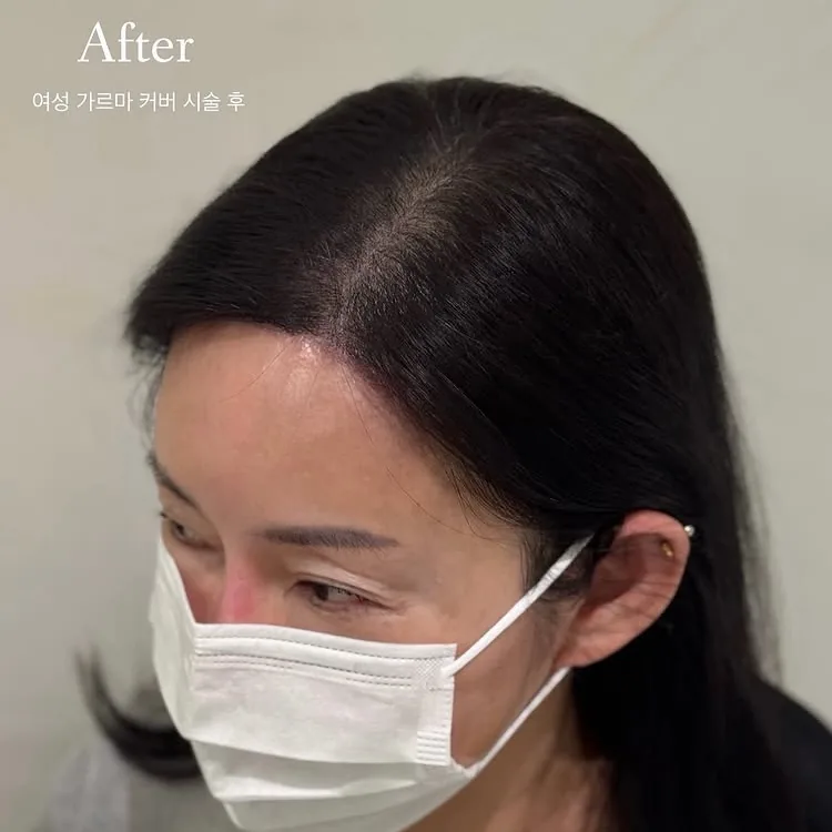 ヘアラインSMP Before After 施術例 18
