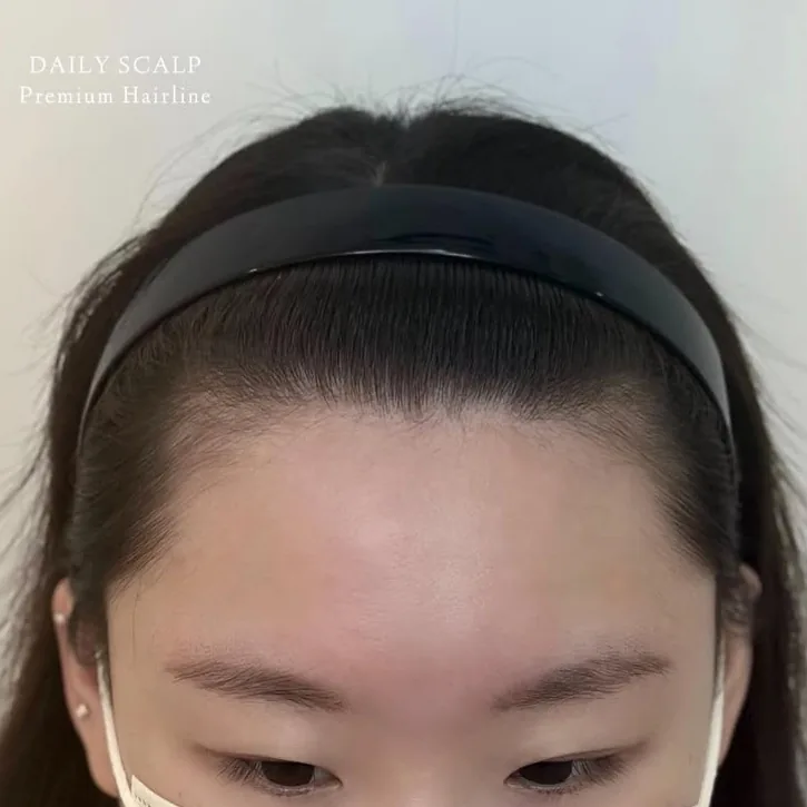 ヘアラインSMP Before After 施術例 1 Before