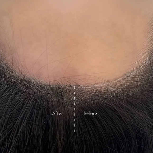 生え際の地肌の見え方を左右で比べたBefore/After — ヘアラインSMP施術例 エステールエステ