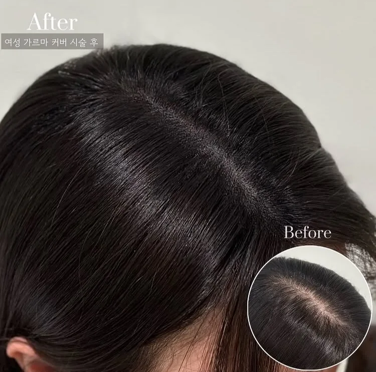 分け目から頭頂部にかけての透けを整えたヘアラインSMPの施術例(右下が施術前) — エステールエステ 弘大