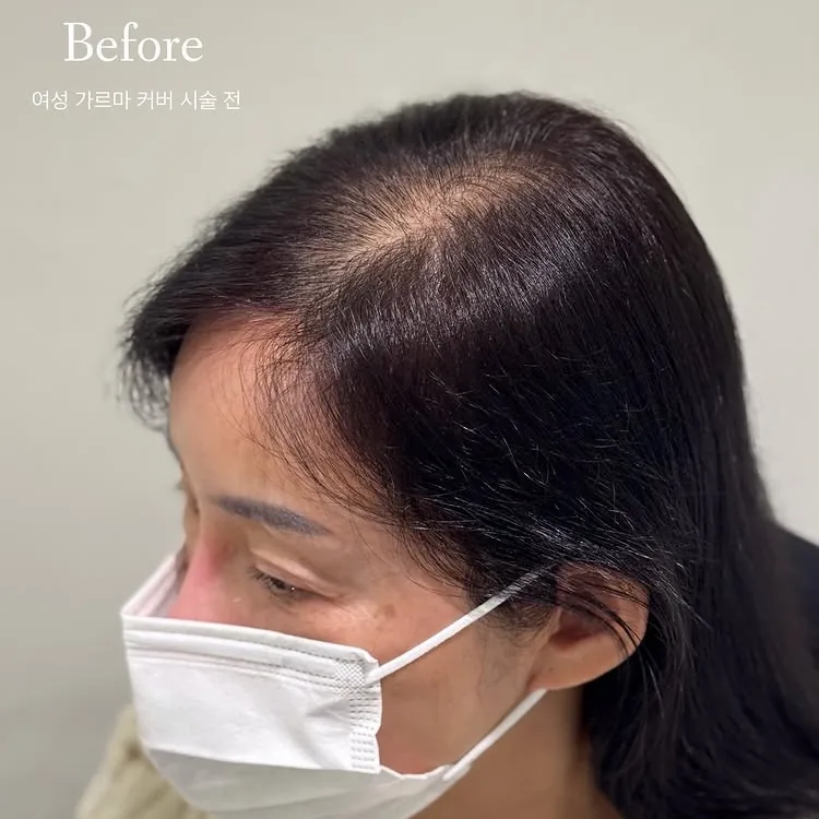 ヘアラインSMP Before After 施術例 5 Before