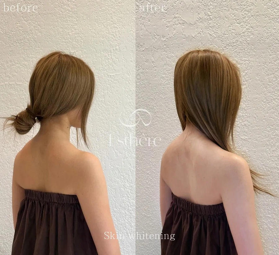 全身ホワイトニングケア Before After 施術例 3