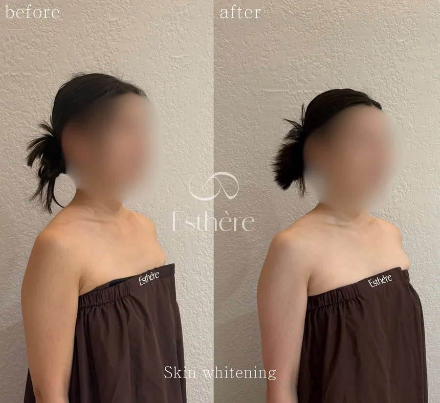 全身ホワイトニングケア Before After 施術例 10