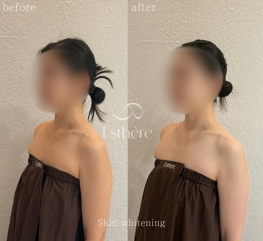 全身ホワイトニングケア Before After 施術例 11