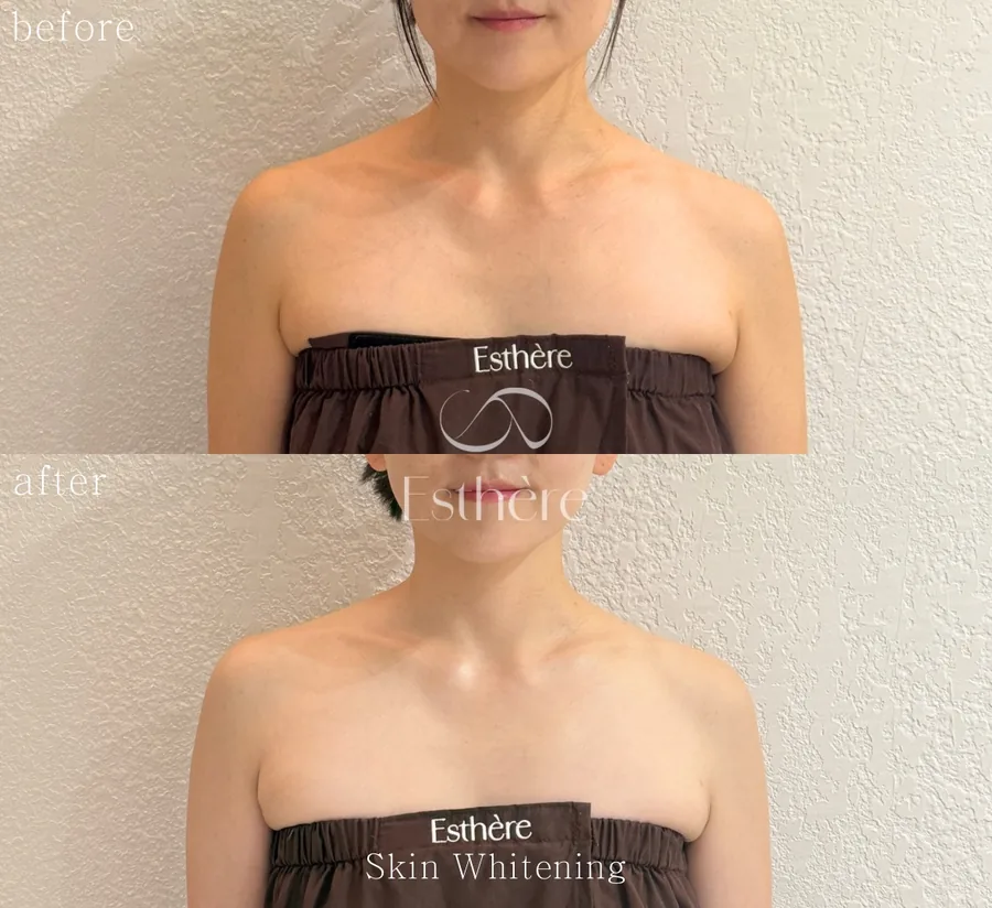 全身ホワイトニングケア Before After 施術例 13