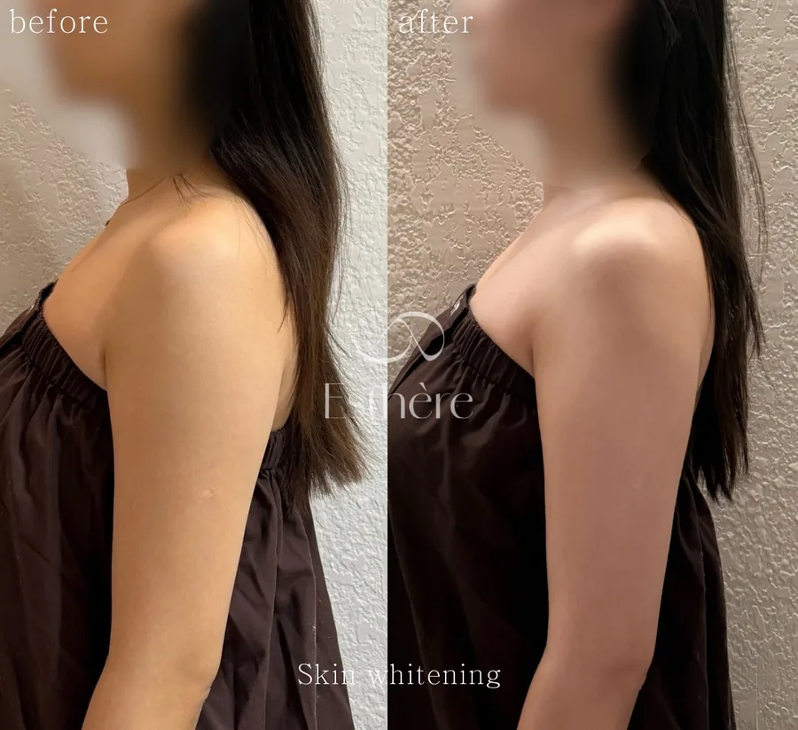 全身ホワイトニングケア Before After 施術例 15