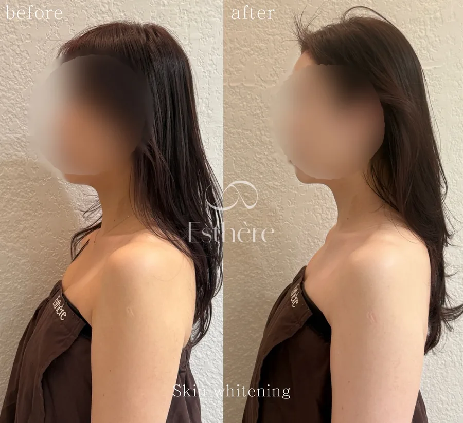 全身ホワイトニングケア Before After 施術例 18