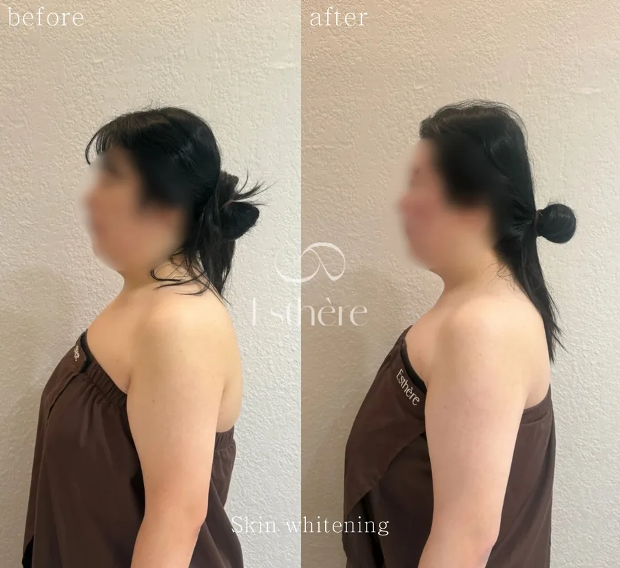 全身ホワイトニングケア Before After 施術例 21