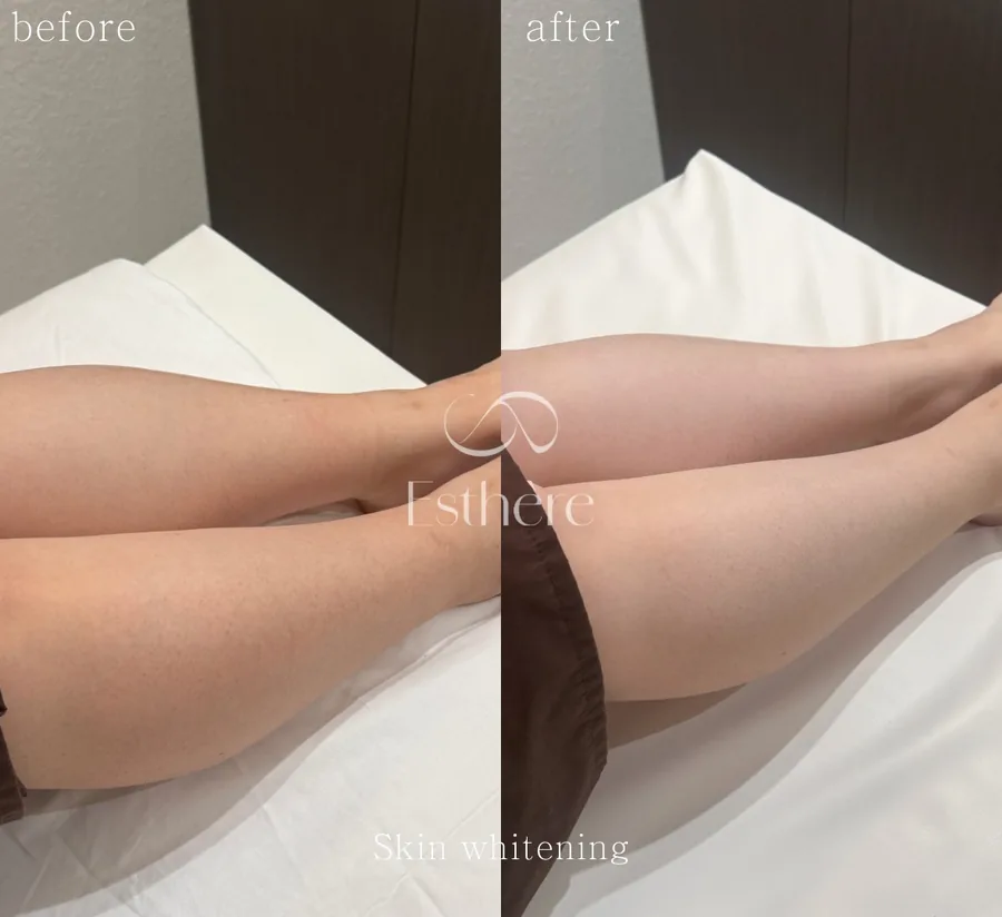 全身ホワイトニングケア Before After 施術例 22
