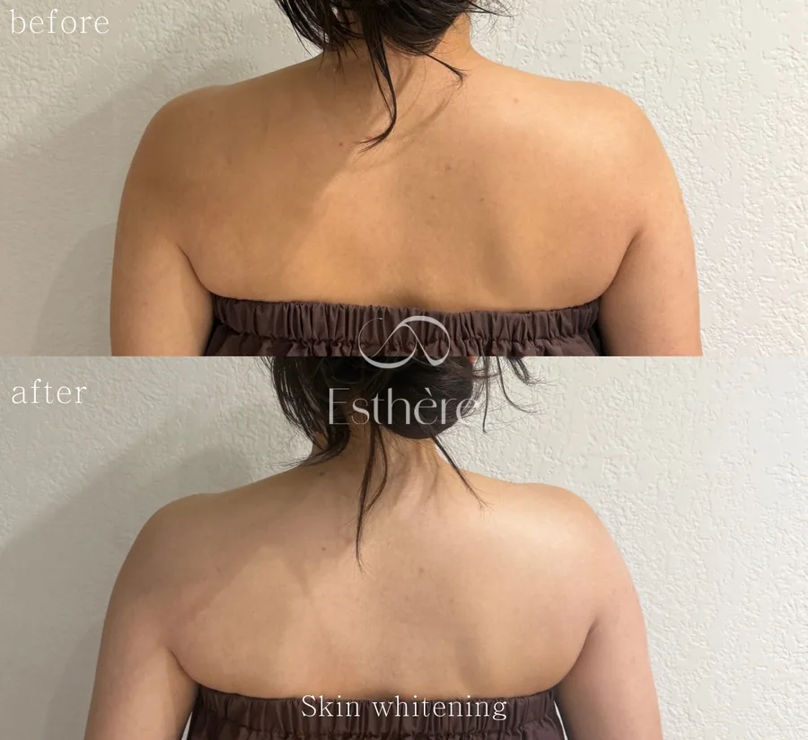 全身ホワイトニングケア Before After 施術例 26