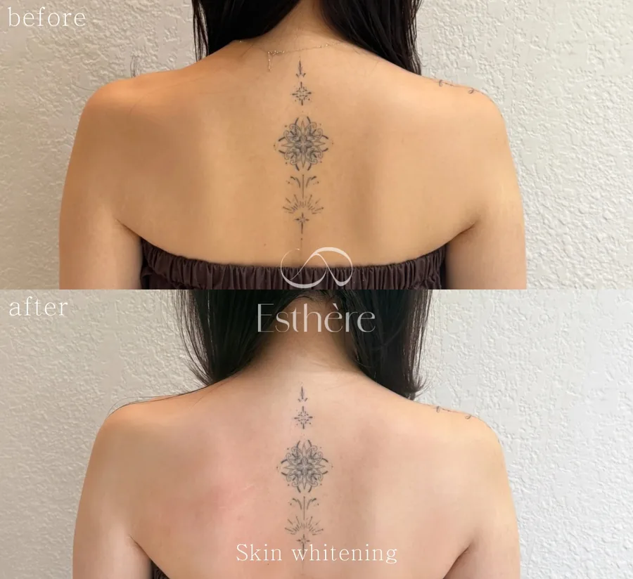 全身ホワイトニングケア Before After 施術例 27