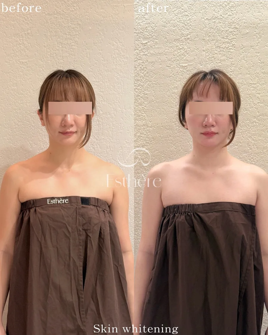 全身ホワイトニングケア Before After 施術例 30
