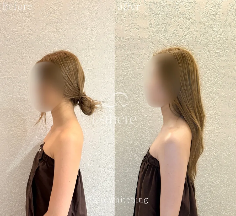 横向きで撮影した首まわりのBefore/After — 全身ホワイトニングケア エステールエステの施術例