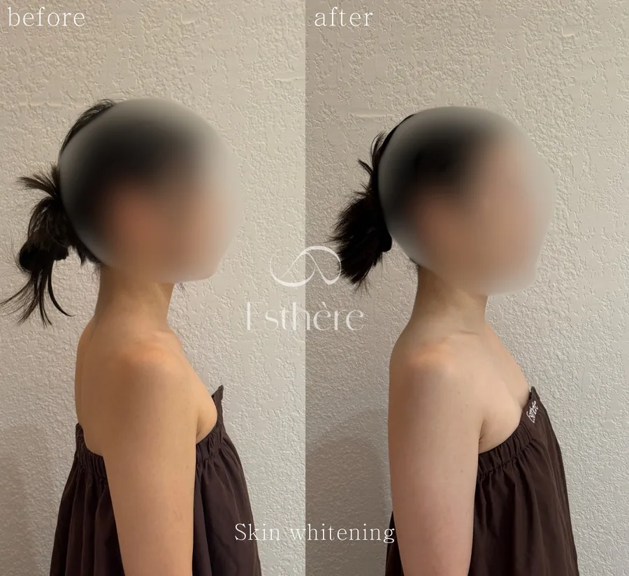 ボディのトーンが変化した全身ホワイトニングケアの Before After 施術例 — エステールエステ