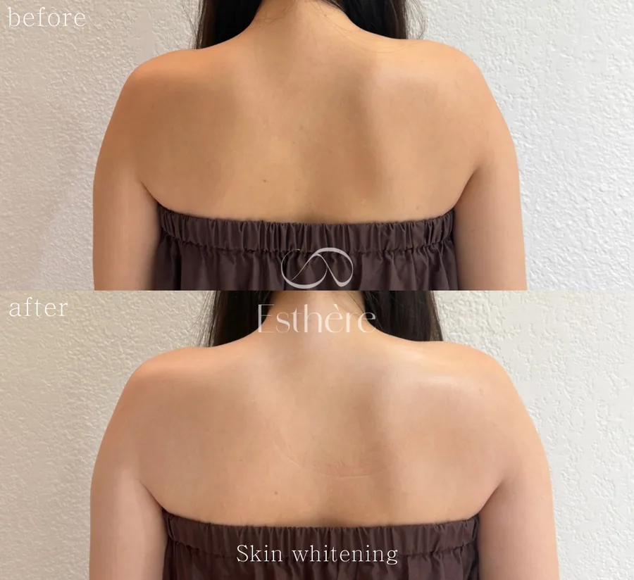 背中と肩まわりのBefore After — 全身トーンアップを目指すケアの施術例 エステールエステ