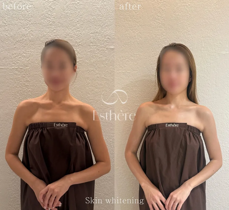 首・デコルテのトーンを並べたBefore Afterの施術例写真 — 全身ホワイトニングケア エステールエステ